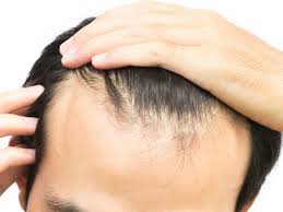 Anti-balding products in nairobi, how to reverse hair loss, anti-baldness hair products Nairobi Kenya