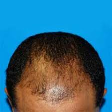 minoximed reviews minoximed side effects minoximed hair minoximed in kenya minoximed price in kenya minoximed where to buy minoximed results minoximed how to us minoximed testimonials minoximed forum minoximed how to order does minoximed work where can i get minoximed in kenya minoxidil spray minoxidil beard minoxidil side effects Nairobi Kenya daresalaam tanzania juba south sudan Khartoum sudan Kigali Rwanda kampala Uganda bunjumbura Burundi kinshasaDRC glutathione injections Maputo Mozambique accra Ghana Dakar Senegal Lusaka Zambia Monrovia angola jibouti asmara Eritrea tunis Tunisia rabat morocco cairo Egypt Harare zimbambwe skin whitening Mauritius Seychelles Pretoria south Africa glutathione shop lagos Nigeria hair growth and baldness products shop capeverde eguitorial guinea mogadishu Somalia adisababa Ethiopia togo Liberia sierraleone minoximed shop africa +254723408602