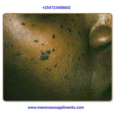 warts removal, papillomas removal, warts treatment, best warts removal drugs, HPV Drugs