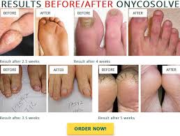 Foot Care, Feet And Nails Care Products, Skin Care Products In Kenya, Toe Nails Care Products, Itching Feet Products