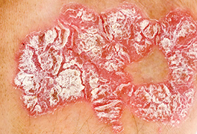 psorifix psorifix reviews psorifix mercury drug psorifix kenya psorifix side effects psorifix price in kenya psorifix ingredients psorifix how to use psorifix benefits psorifix testimonials where to buy psorifix psorifix dosage is psorifix effective psorifix benefits psorifix Africa stores Nairobi Kenya daresalaam tanzania juba south sudan Khartoum sudan Kigali Rwanda kampala Uganda bunjumbura Burundi kinshasaDRC glutathione injections Maputo Mozambique accra Ghana Dakar Senegal Lusaka Zambia Monrovia angola jibouti asmara Eritrea tunis Tunisia rabat morocco cairo Egypt Harare zimbambwe skin whitening Mauritius Seychelles Pretoria south Africa glutathione shop lagos Nigeria hair growth and baldness products shop capeverde eguitorial guinea mogadishu Somalia adisababa Ethiopia togo Liberia sierraleone psorifix cream shop africa +254723408602