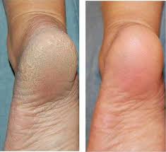 tinedol tinedol foot cream foot care foot cracking foot pain cream cracking foot solution athletes foot cure tinedol cream nairobi kenya +254723408602 tinedol cream reviews tinedol cream side effects Nairobi Nairobi Kenya daresalaam tanzania juba south sudan Khartoum sudan Kigali Rwanda kampala Uganda bunjumbura Burundi kinshasaDRC glutathione injections Maputo Mozambique accra Ghana Dakar Senegal Lusaka Zambia Monrovia angola jibouti asmara Eritrea tunis Tunisia rabat morocco cairo Egypt Harare zimbambwe erectile dysfunction treatment Mauritius Seychelles Pretoria south Africa bunion feet gel shop lagos Nigeria hair growth and baldness products shop capeverde eguitorial guinea mogadishu Somalia adisababa Ethiopia togo Liberia sierraleone cracked foot gel foot care gels shop africa +254723408602