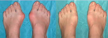 valgorect cream valgorect cream reviews valgorect foot care gel valgorect price valgorrect side effects valgorect how to use valgorect ingredients Nairobi Nairobi Kenya daresalaam tanzania juba south sudan Khartoum sudan Kigali Rwanda kampala Uganda bunjumbura Burundi kinshasaDRC glutathione injections Maputo Mozambique accra Ghana Dakar Senegal Lusaka Zambia Monrovia angola jibouti asmara Eritrea tunis Tunisia rabat morocco cairo Egypt Harare zimbambwe erectile dysfunction treatment Mauritius Seychelles Pretoria south Africa bunion feet gel shop lagos Nigeria hair growth and baldness products shop capeverde eguitorial guinea mogadishu Somalia adisababa Ethiopia togo Liberia sierraleone bunion foot care gels shop africa +254723408602