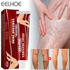 varicose veins treatment cream, varicose veins treatment cost, varicose veins treatment medicine, best treatment for varicose veins, varicose veins treatment in ayurveda, how to cure varicose veins with vinegar, varicose veins causes, when to worry about varicose.